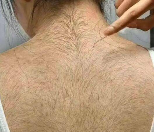 女性多毛症