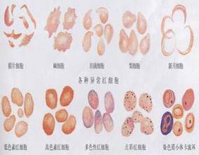 红细胞沉降