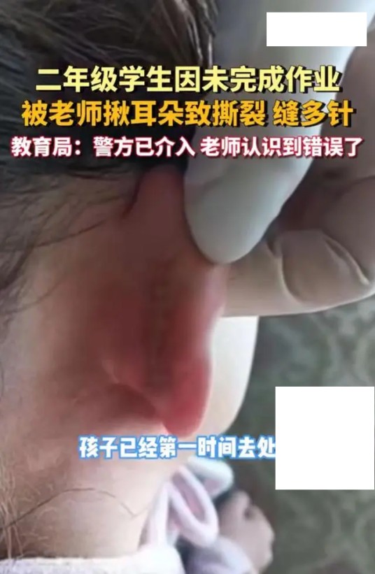 11·25鄂尔多斯学生被老师揪耳朵致撕裂事件