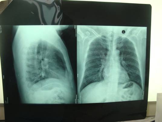 隐源性机化性肺炎