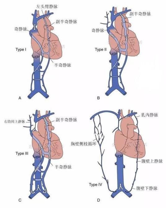 腔静脉阻塞综合征