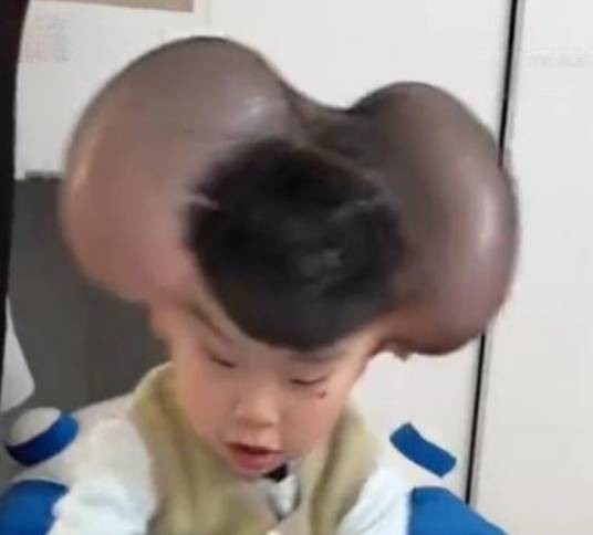 琪宝（患有先天性巨痣和多发痣的男童）